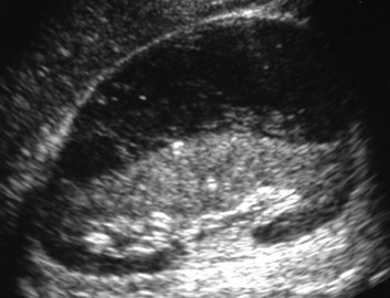Muniz-subcapsular abscess-US1