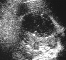 Muniz-subcapsular abscess-US2