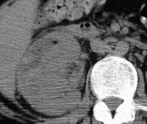 Muniz-subcapsular abscess-CT