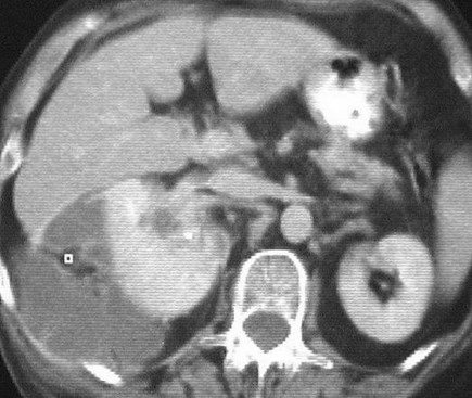 Leese-loculated perinephric abscess-CT