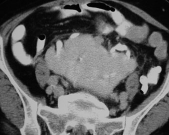 Wilson-  pyelo in pancake kidney-kidney-level- CT2