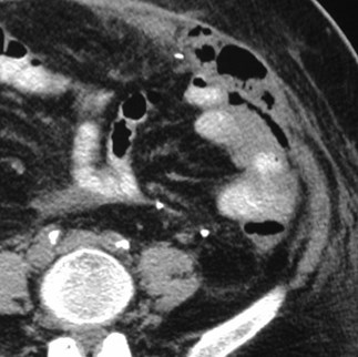 Lee-hemicolectomy-abd wall muscles gas-CT3