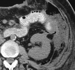 Lee-hemicolectomy-antpara to extraperit-CT2