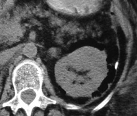 Lee-hemicolectomy-perinephric gas-CT1