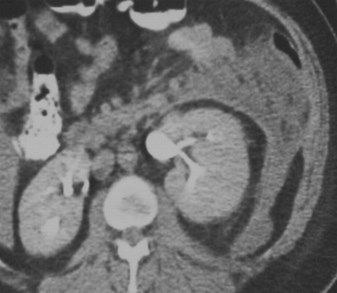 Kenner-pancreatitis-antpara space-CT1