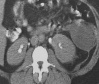 Kenner-pancreatitis-antpara space-CT2 BMP