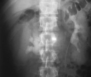IVP subcapsular collection