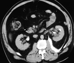 Silverman-postpararenal-CT1