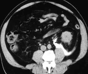 Silverman-postpararenal-CT2