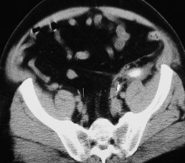 Silverman-postpararenal-CT3