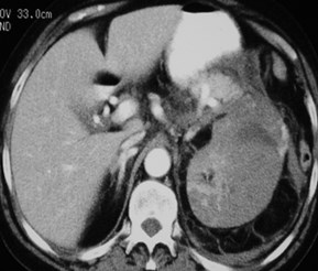 Conyers-subcapsular hemat to antpararen space-CT1