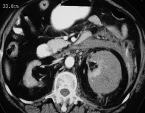 Conyers-subcapsular hemat to antpararen space-CT2