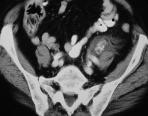 Conyers-subcapsular hemat to antpararen space-CT4