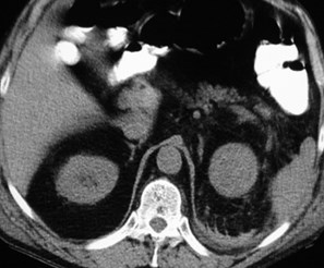 Perry-RCC with subcap bleed-CT3