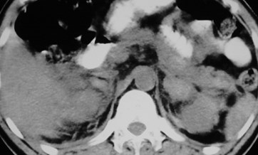 Tan-trauma, adrenal to perinephric-CT1