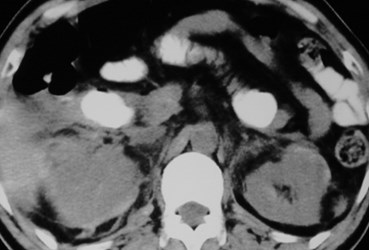 Tan-trauma, adrenal to perinephric-CT2