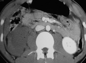 Trauma- Renal A