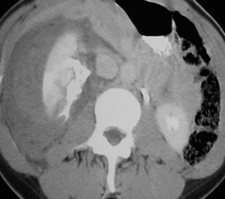 Grose-FX kidney delay-CT2 with extrav