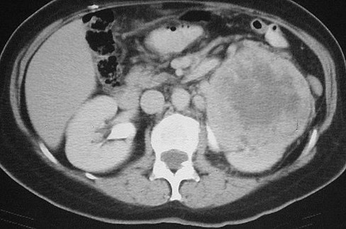 Adair- CT-RCC to Gerota's Fascia