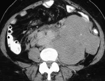 Armstrong-massive lymphome CT below kidneys