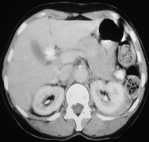 Johnson-perirenal lymphomaCT-11-6-93