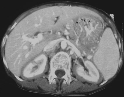 Nhek-bilat perirenal lymphoma CT