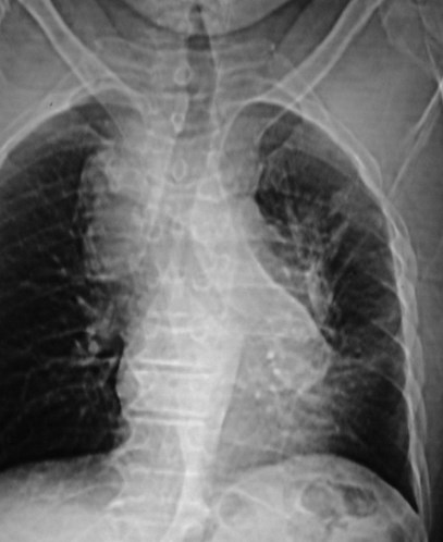 Hutchinson-lung CA-mets-chest scout film