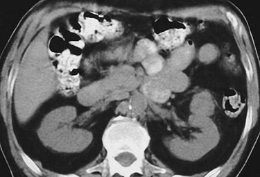 Hutchinson-lung CA mets-left perinephric-CT