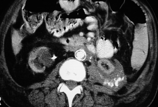 Ramsey-RPF into L perinephric space-CT