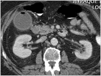 C:\Users\Ryan\Desktop\Desktop Data\Radiology\Multiple Case Conference\Acute Non GI Cases\3. Emphysematous chole on 2 studies ct\CT axial first study 1.jpg