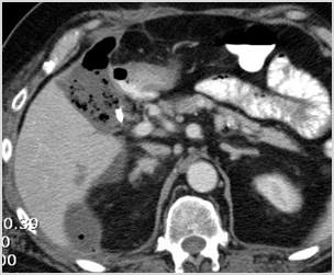 C:\Users\Ryan\Desktop\Desktop Data\Radiology\Multiple Case Conference\Acute Non GI Cases\3. Emphysematous chole on 2 studies ct\CT axial second study 2.jpg