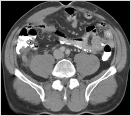 C:\Users\Ryan\Desktop\Desktop Data\Radiology\TEACHING FILES\Bowel\acute appy\CT\ser003img00049.jpg