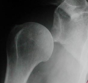 sublux humeral head paralyzed patient