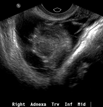 trv ROV 2 w adhesions.jpg
