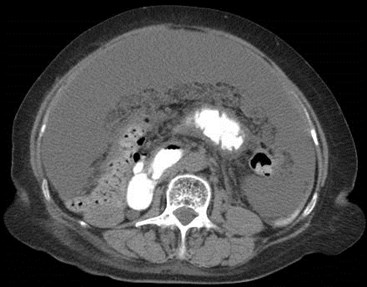 CT 2