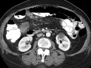 tumor omentum