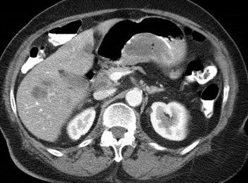 mucosal gastric mass, ulcerated