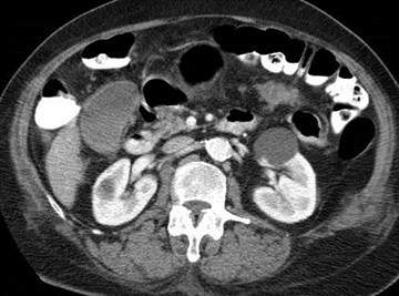 trumor trv mesocolon 1