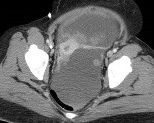ax uterine, peritoneal mets