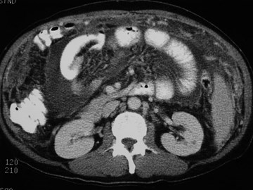 Peritoneal TB-3