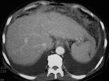 Periotoneal TB-1