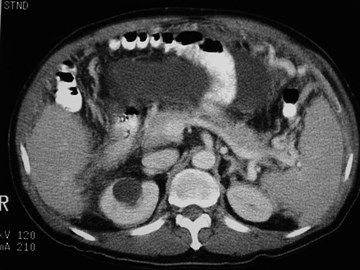 Peritoneal TB-2