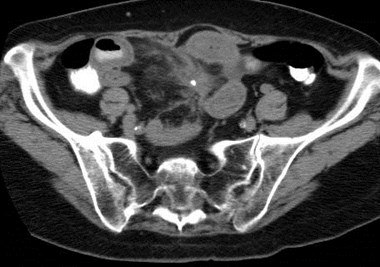 Morgan,Lorraine, carcinoid CT-1