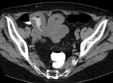 Morgan,Lorraine, carcinoid CT-3