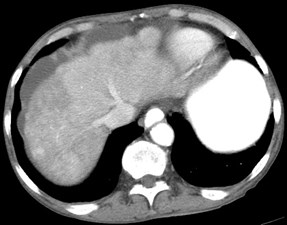 pseudocirrhosis.jpg