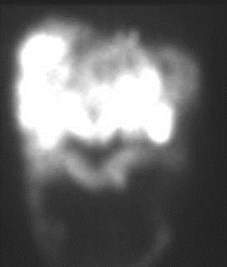 octreotide pos liver, abd