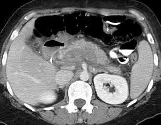 sv thrombus