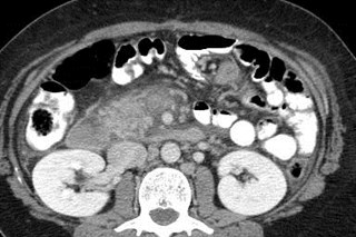 smv thrombus