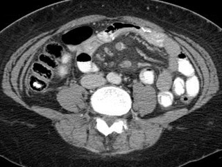 mes v thrombus