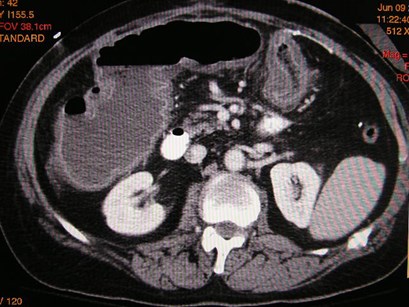 1st CT with ischemic colon-removed